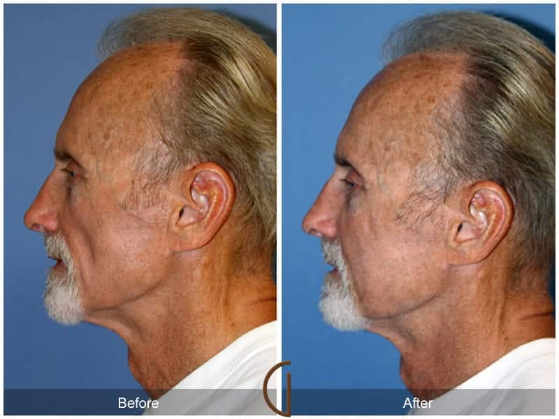 Facial Fat Grafting Laguna Hills CA 6 Image