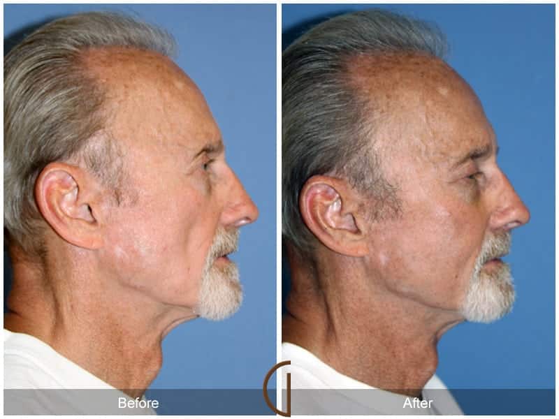 Facial Fat Grafting Laguna Hills CA 6 Image