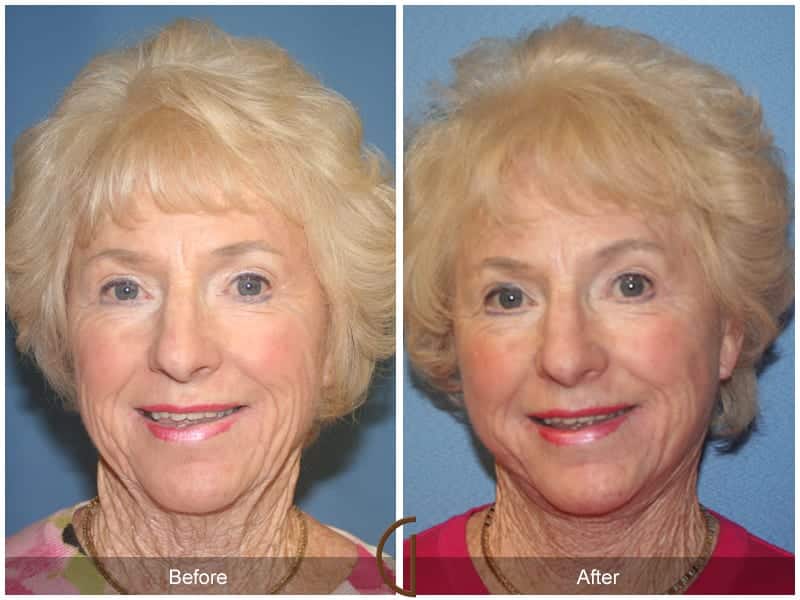 Facelift Newport Beach 224 Image