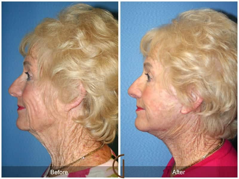 Facelift Newport Beach 224 Image