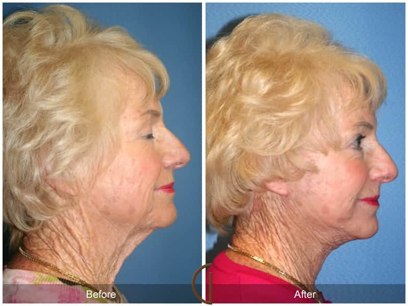 Facelift Newport Beach 224 Image