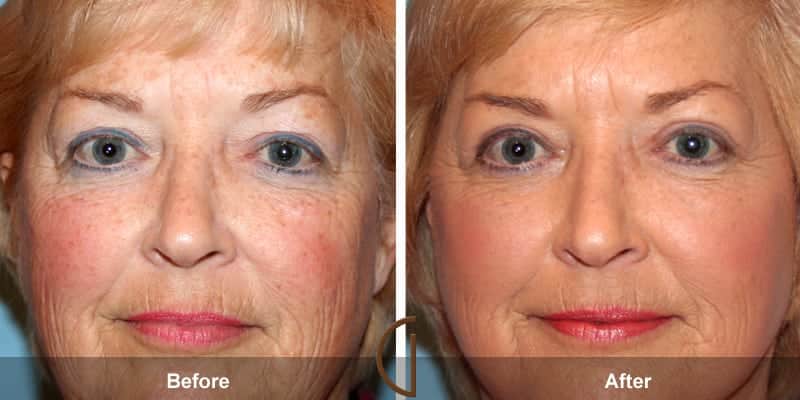 Eyelid Surgery Orange County 43 Image
