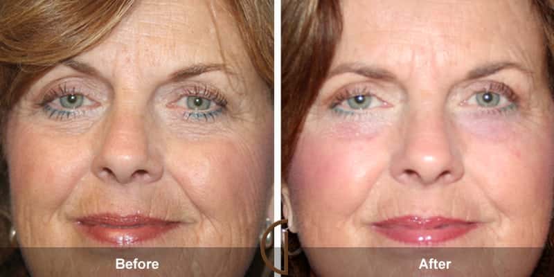 Eyelid Surgery Orange County 50 Image