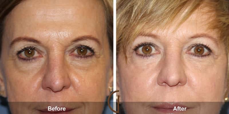 Eyelid Surgery Orange County 51 Image