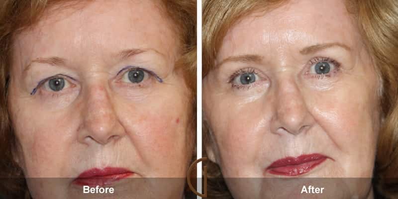 Eyelid Surgery Newport Beach 52 Image