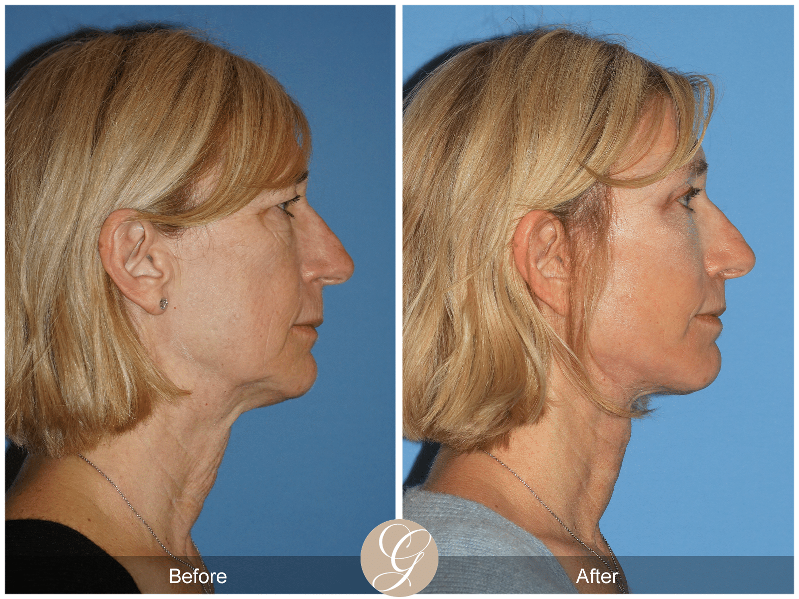 Vertical Facelift Case 2 Image