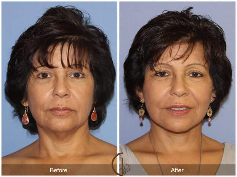 Facelift Results Newport Beach Image