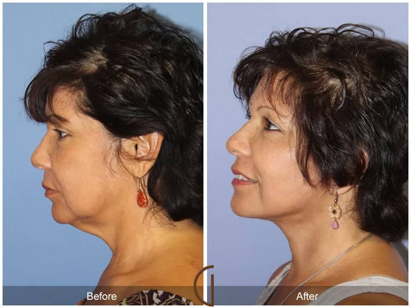 Facelift Results Newport Beach Image