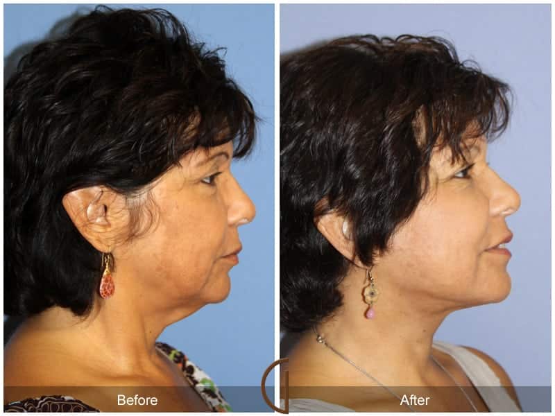 Facelift Results Newport Beach Image