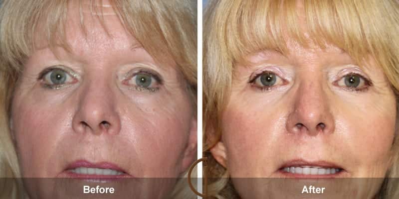 Eyelid Surgery Newport Beach 53 Image