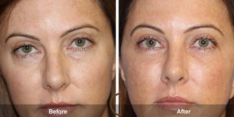 Eyelid Surgery Newport Beach 54 Image