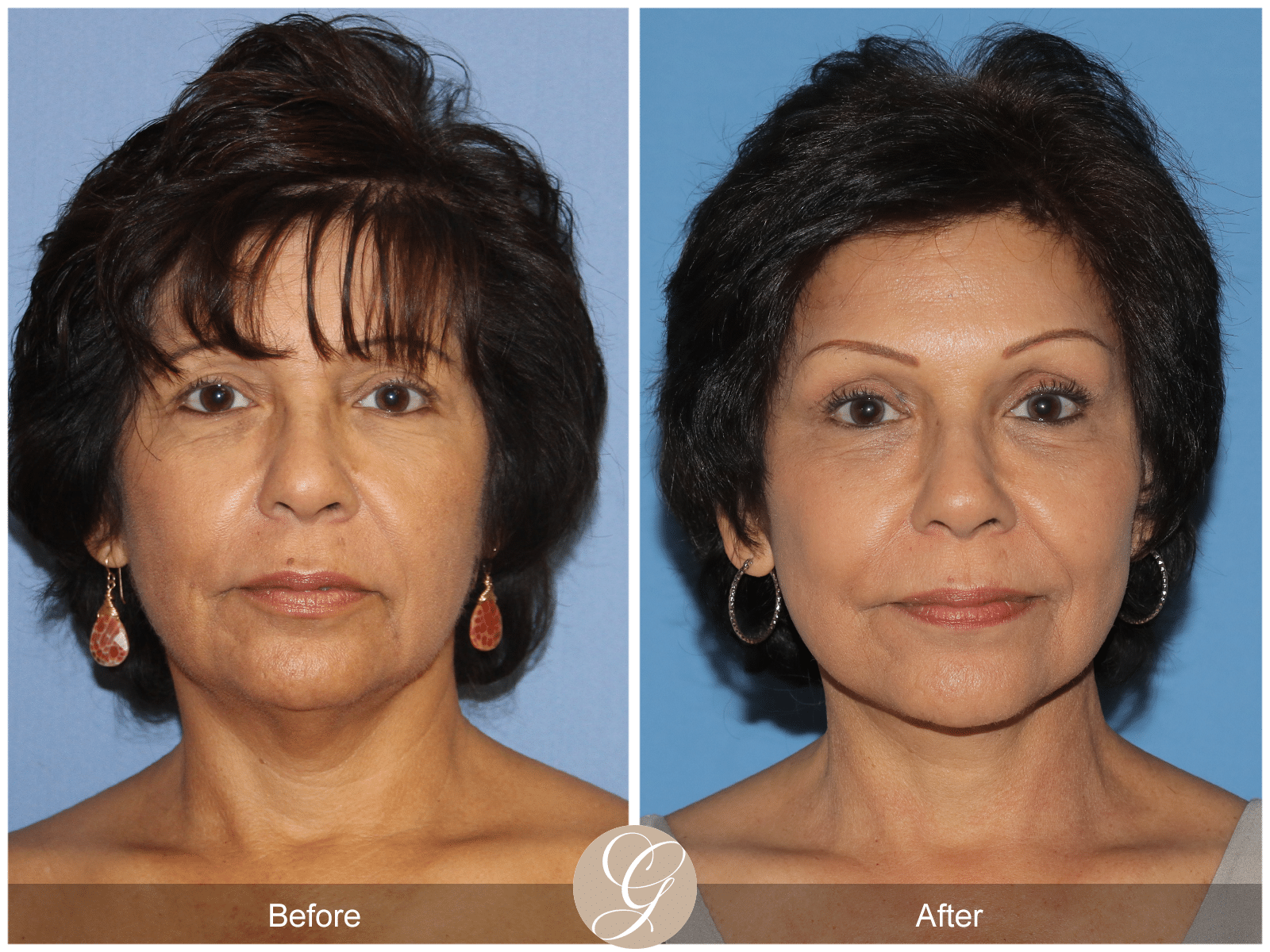 Vertical Facelift Case 1 Image