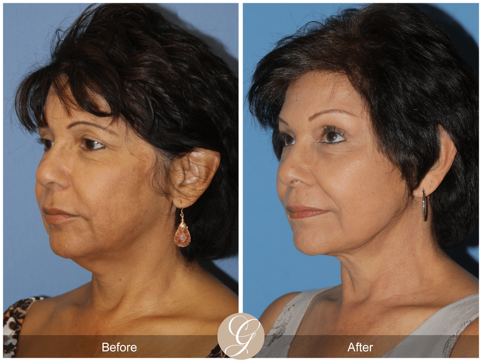 Vertical Facelift Case 1 Image