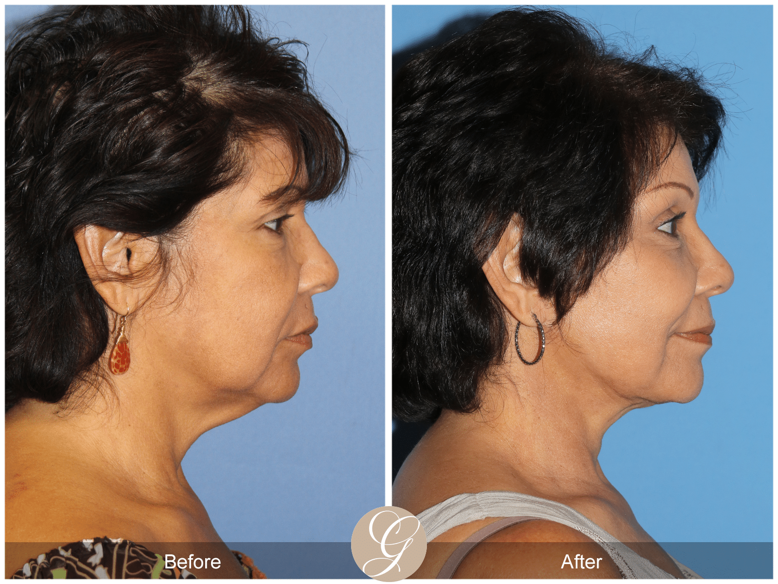 Vertical Facelift Case 1 Image