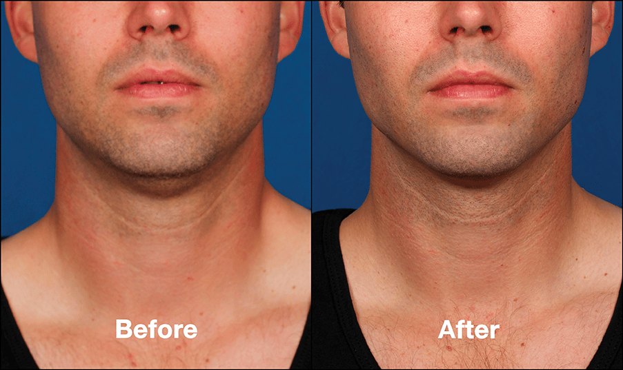 Other Uses for KYBELLA? Image