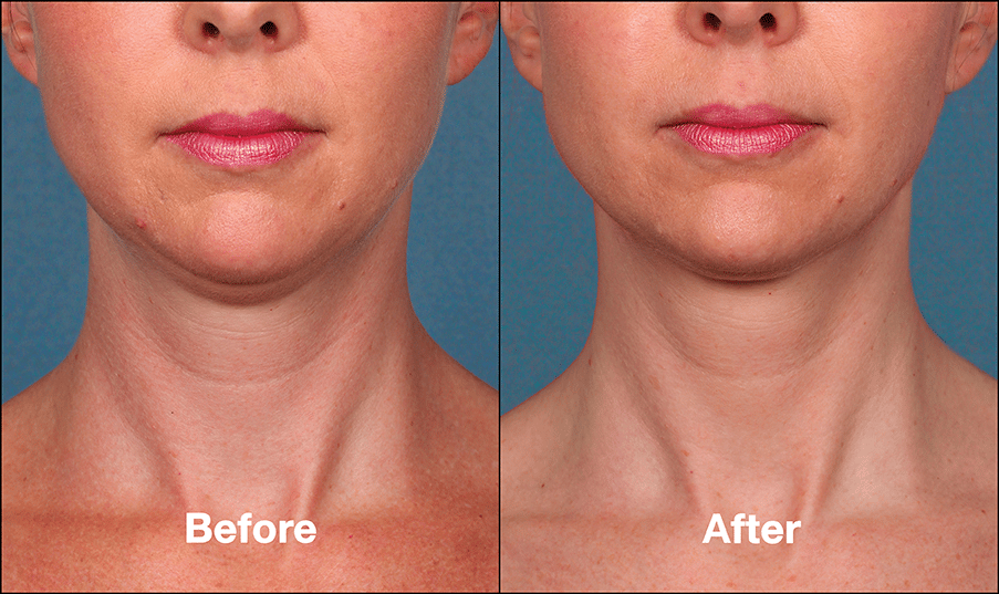Kybella at The Gallery of Cosmetic Surgery Image
