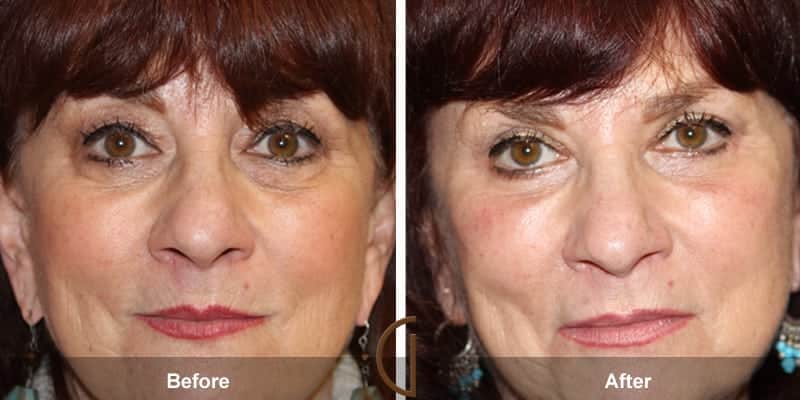 Eyelid Surgery Newport Beach 55 Image