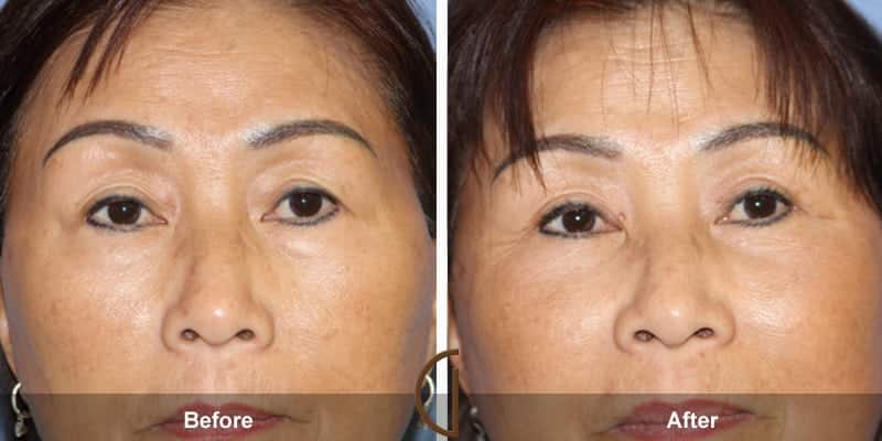 Eyelid Surgery Newport Beach 56 Image