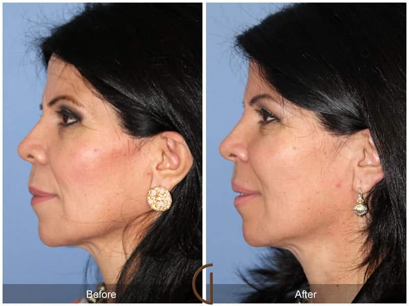 Facial Fat Grafting Placentia CA 15 Image
