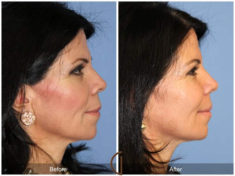 Facial Fat Grafting Placentia CA 15 Image