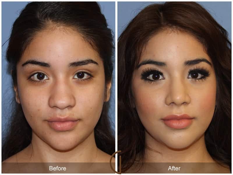 Ethnic Rhinoplasty Newport Beach 85 Image