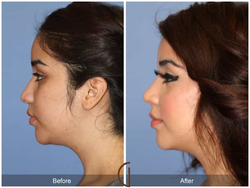 Ethnic Rhinoplasty Newport Beach 85 Image