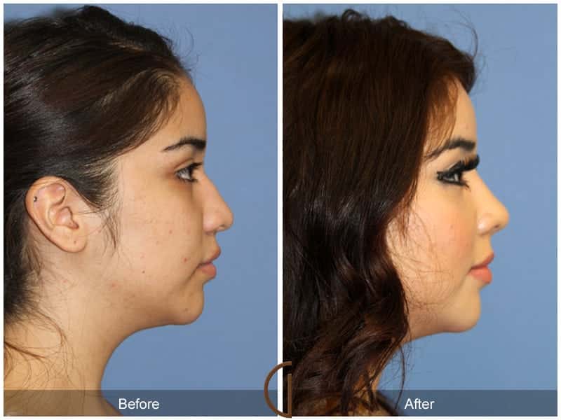 Ethnic Rhinoplasty Newport Beach 85 Image