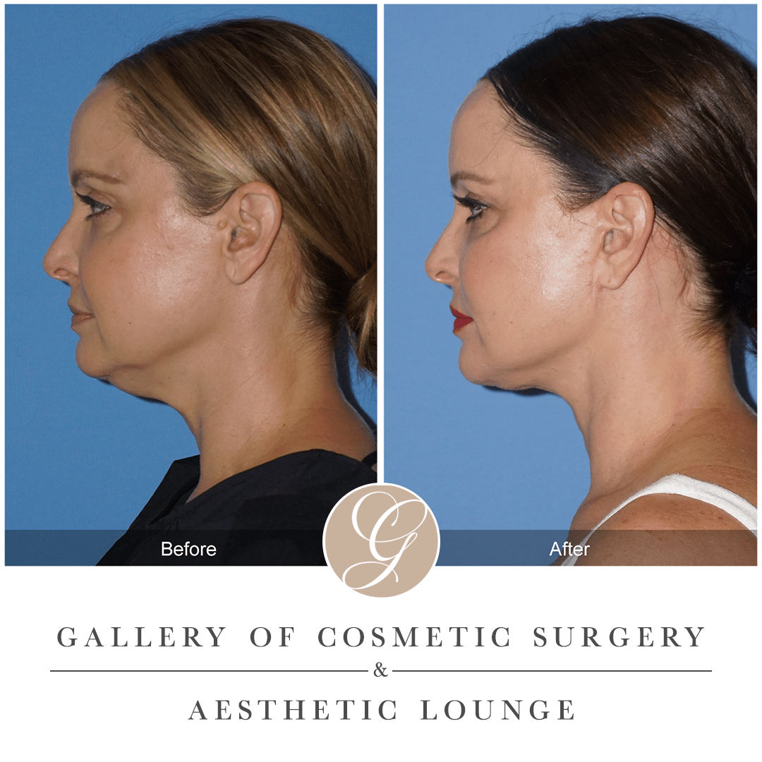 What is Buccal Fat Removal?