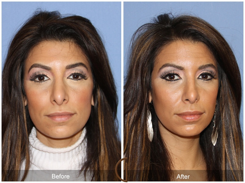 Ethnic Rhinoplasty Nose Surgery Acton 71 Image