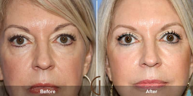 Eyelid Surgery Newport Beach 57 Image