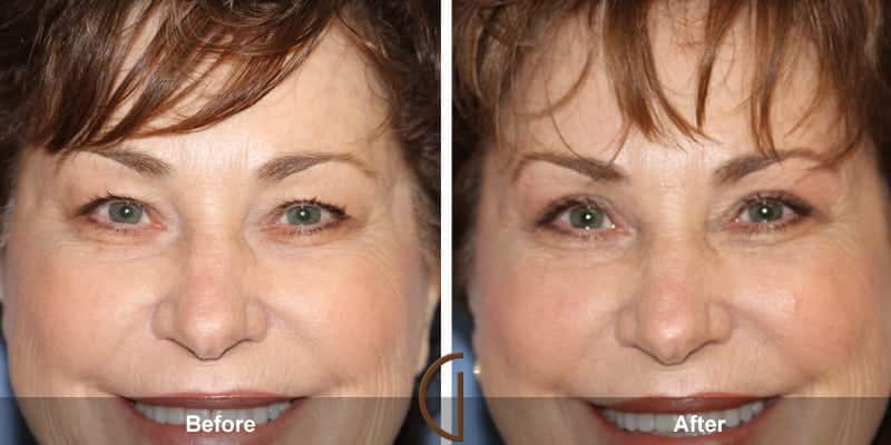 Eyelid Surgery Newport Beach 58 Image