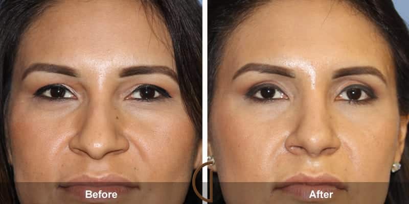 Eyelid Surgery Newport Beach 59 Image