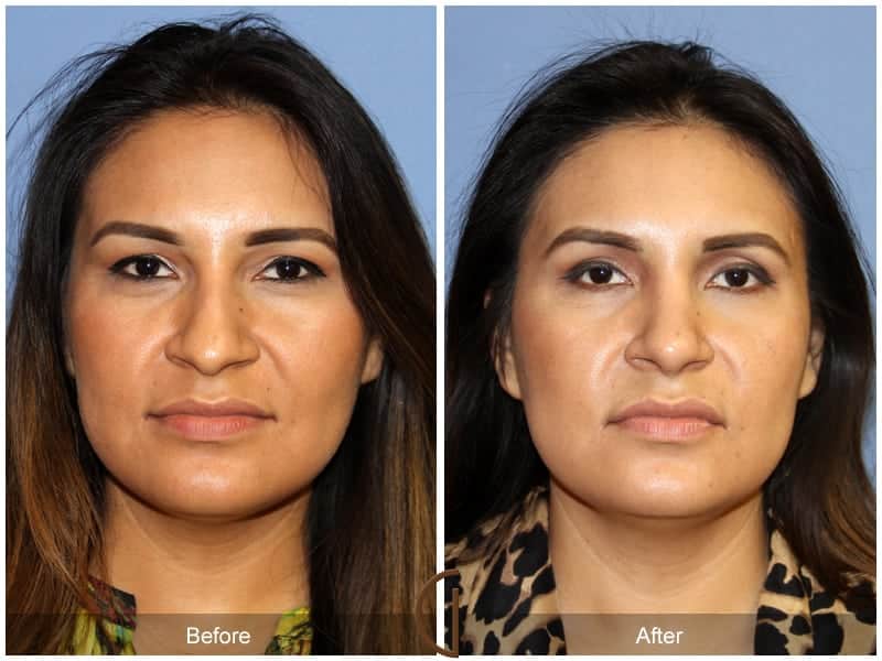 Ethnic Rhinoplasty Newport Beach 86 Image