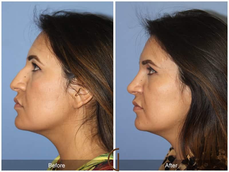 Ethnic Rhinoplasty Newport Beach 86 Image