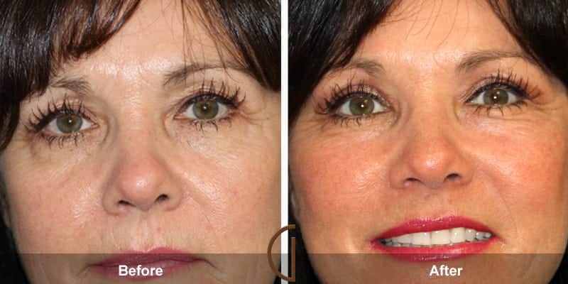 Eyelid Surgery Orange County 42 Image