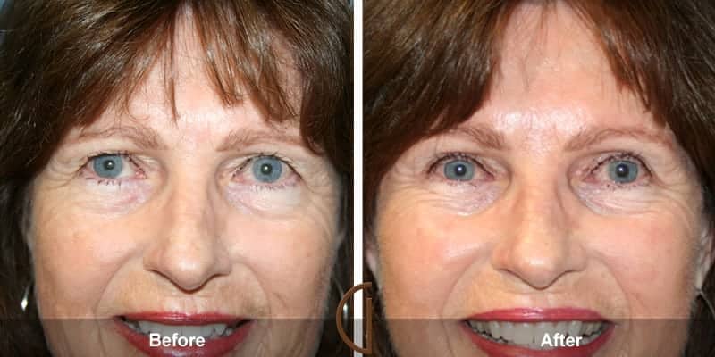 Eyelid Surgery Newport Beach 60 Image