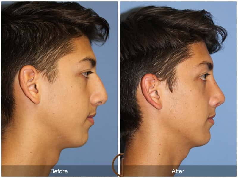 Male Rhinoplasty Corona Del Mar CA 102 Image