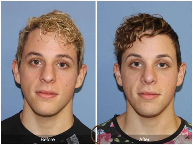 Male Rhinoplasty Long Beach CA  101 Image