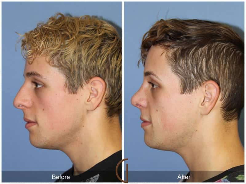 Male Rhinoplasty Long Beach CA  101 Image