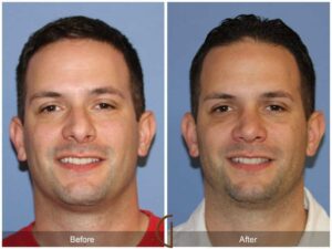 Male Rhinoplasty Mission Viejo CA