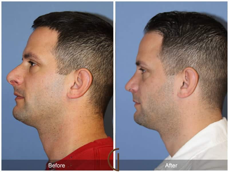 Male Rhinoplasty Mission Viejo CA 100 Image