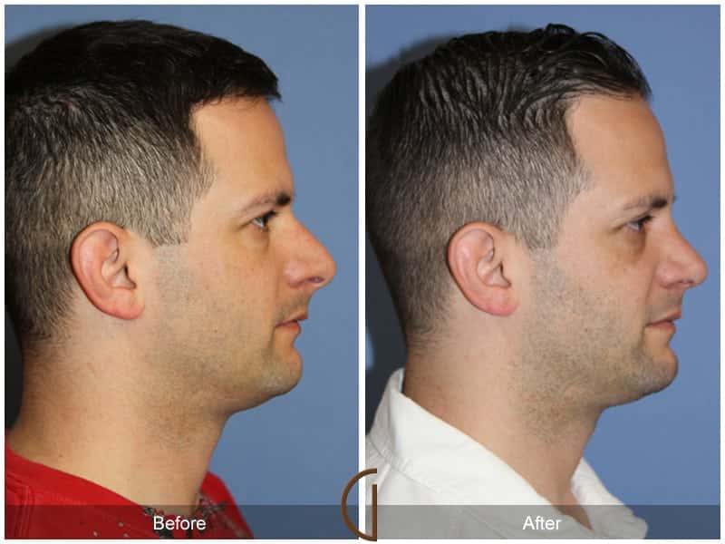 Male Rhinoplasty Mission Viejo CA 100 Image