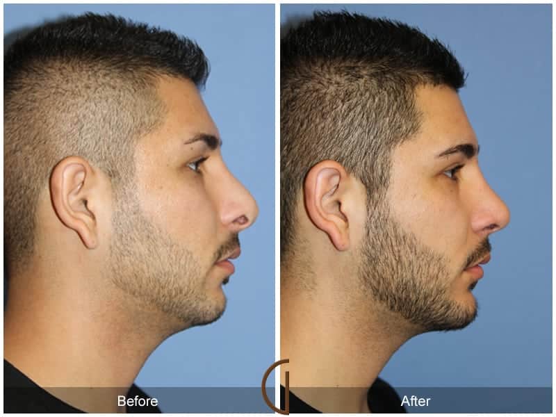 Male Rhinoplasty Riverside CA 104 Image