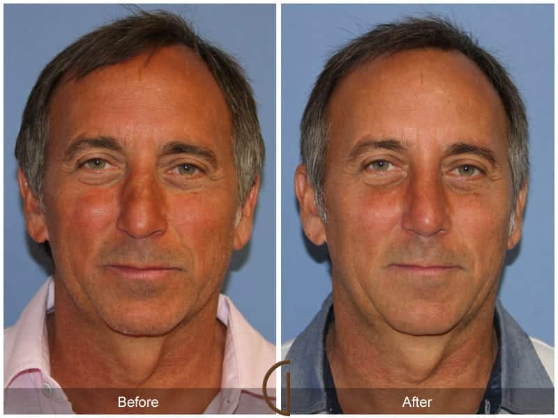 Male Rhinoplasty Santa Ana CA 105 Image