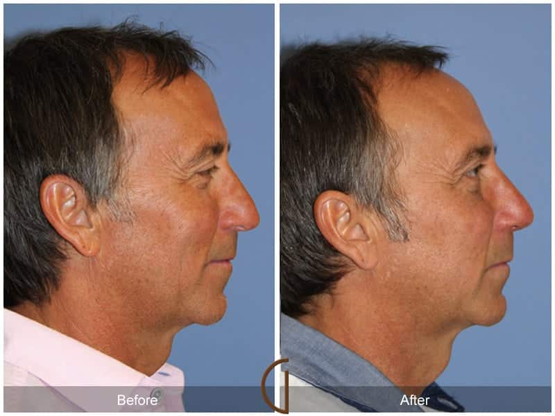 Male Rhinoplasty Santa Ana CA 105 Image