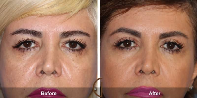 Eyelid Surgery Orange County 41 Image
