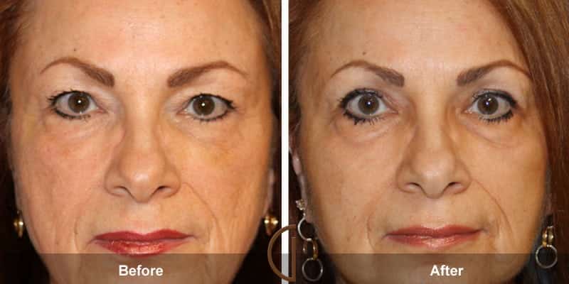 Eyelid Surgery Orange County 40 Image