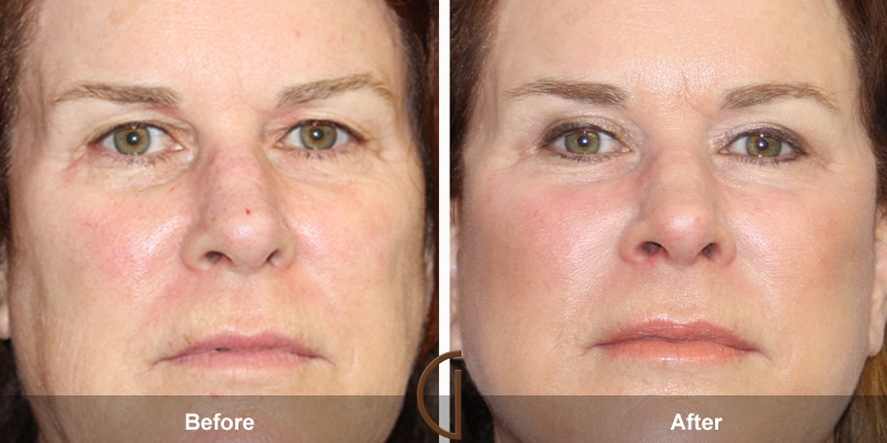 Eyelid Surgery Ladera Ranch CA 12 Image