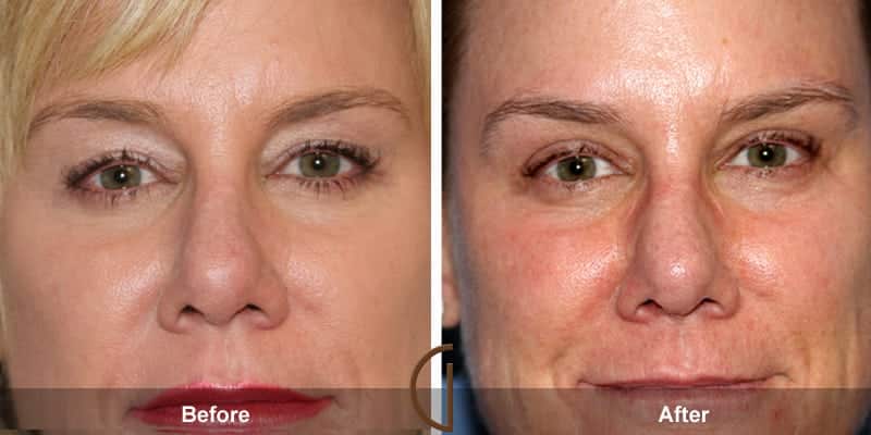 Eyelid Surgery Orange County 37 Image
