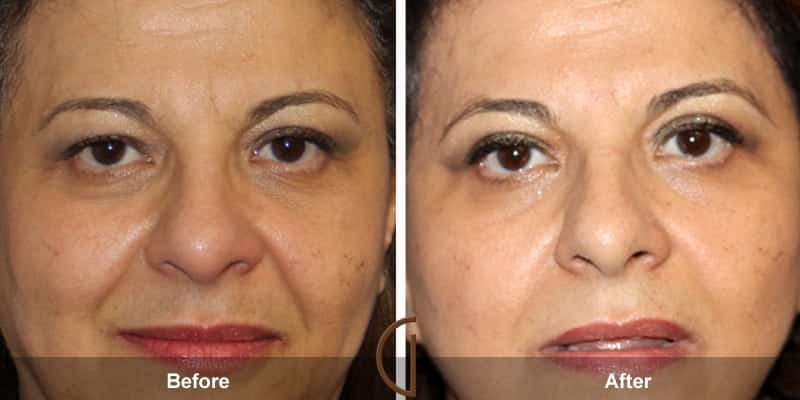 Eyelid Surgery Orange County 36 Image